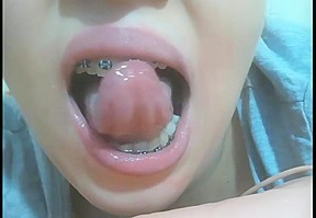 Mouth fetish braces