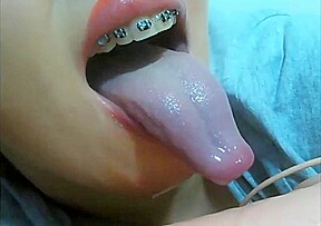 Mouth fetish braces